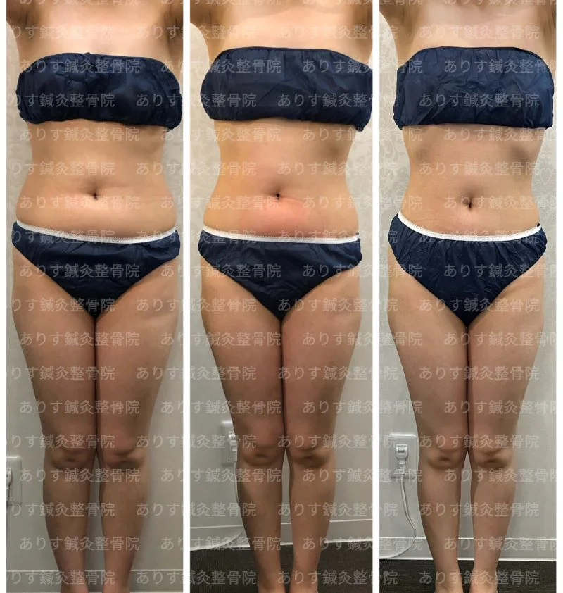 脂肪冷却 パッド式脂肪冷却機「CRYO8S」新登場 パッド式は痛くなく無理なく脂肪